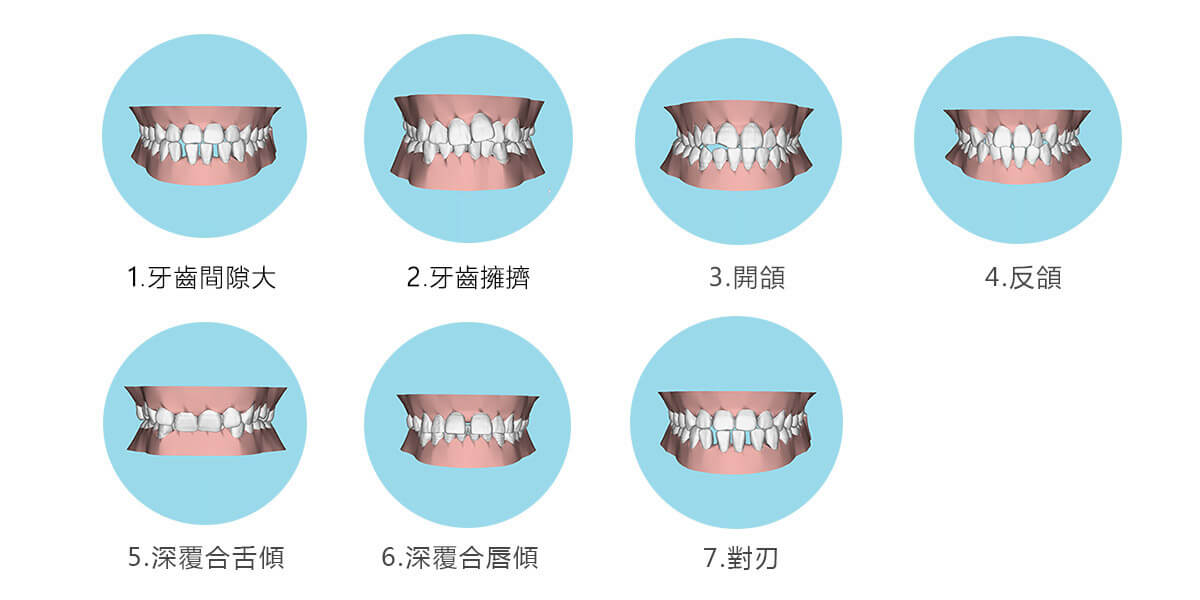 類型