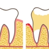 牙齦萎縮有咩危害咧？珠海牙周治療收費？