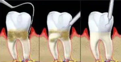 珠海牙周治疗