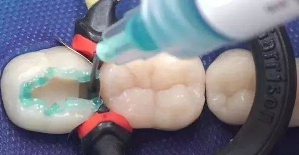 珠海蛀牙補牙