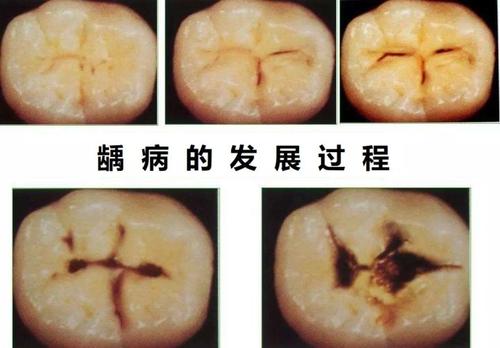 珠海蛀牙補牙