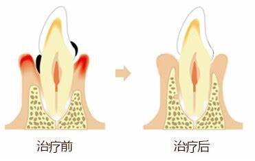 珠海牙周治療