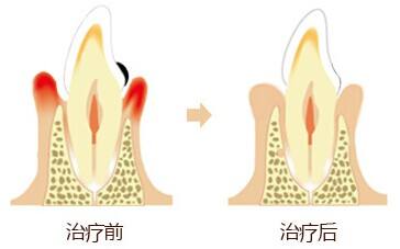 牙周炎