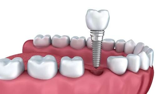 珠海種植牙