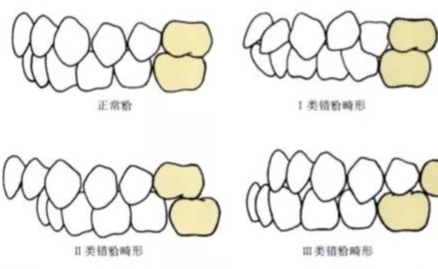 珠海箍牙