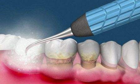 珠海牙周洗牙