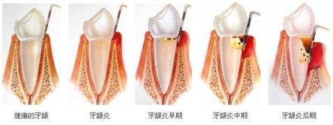 珠海牙周治療