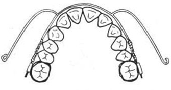 珠海箍牙