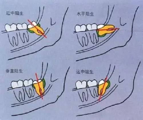 珠海拔智齒