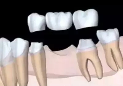 珠海镶牙補牙