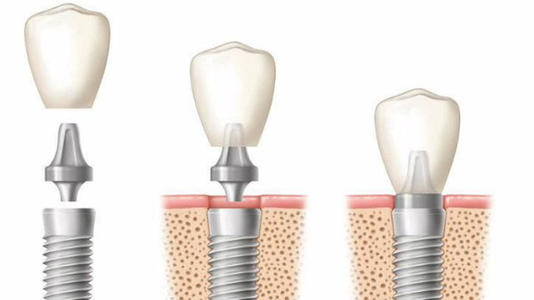 種植牙成功標準