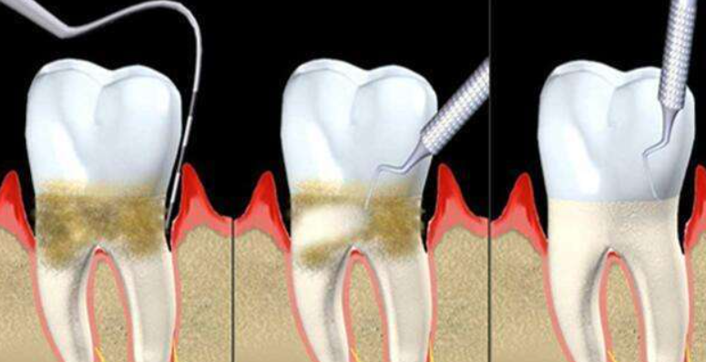珠海牙周治療