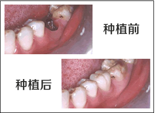 珠海植牙專科