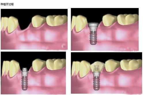 種植牙過程