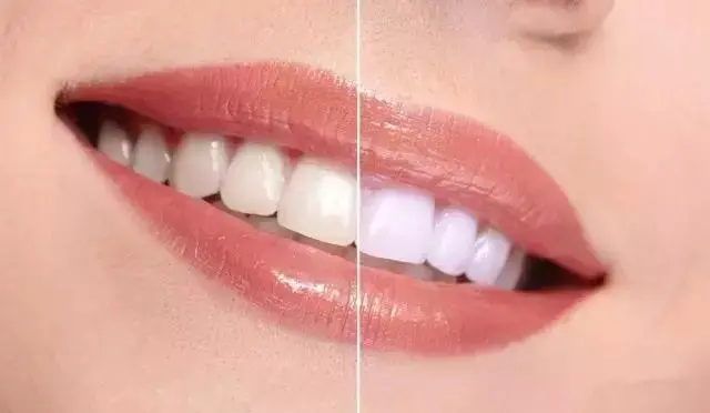 珠海牙齒美白