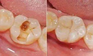 珠海補牙