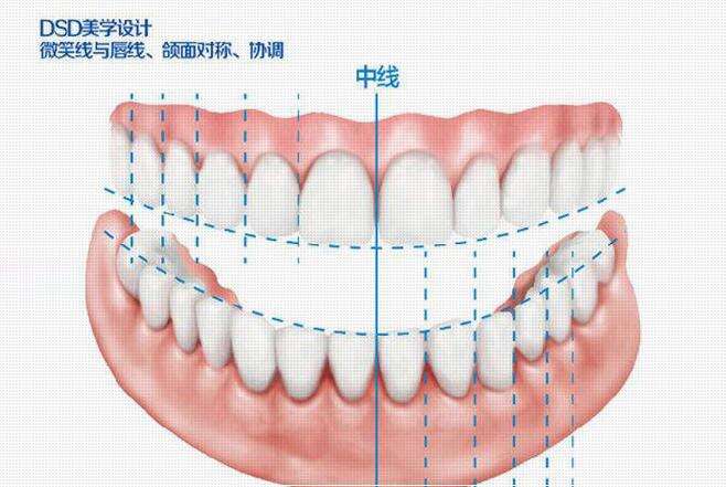 深圳牙齒貼面