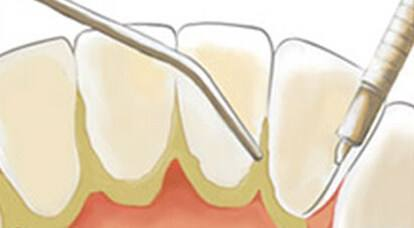 珠海牙周治療